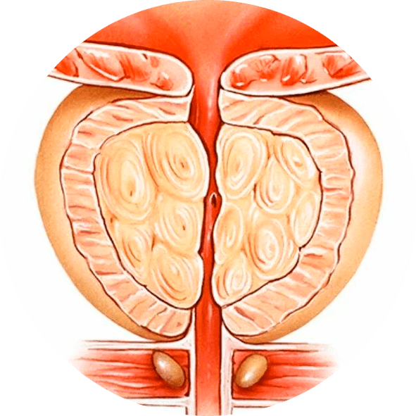 Conseguenze della prostatite non trattata