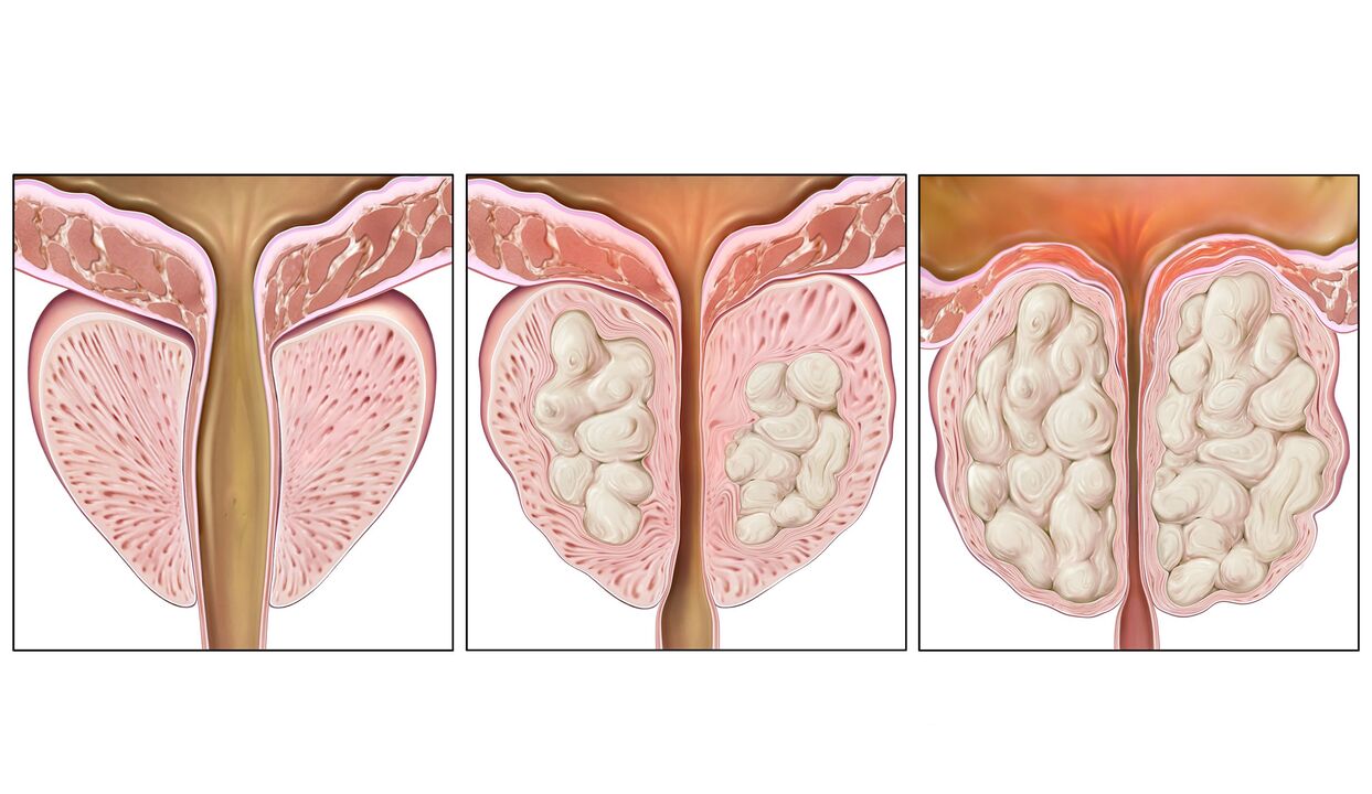 Fasi del cancro alla prostata