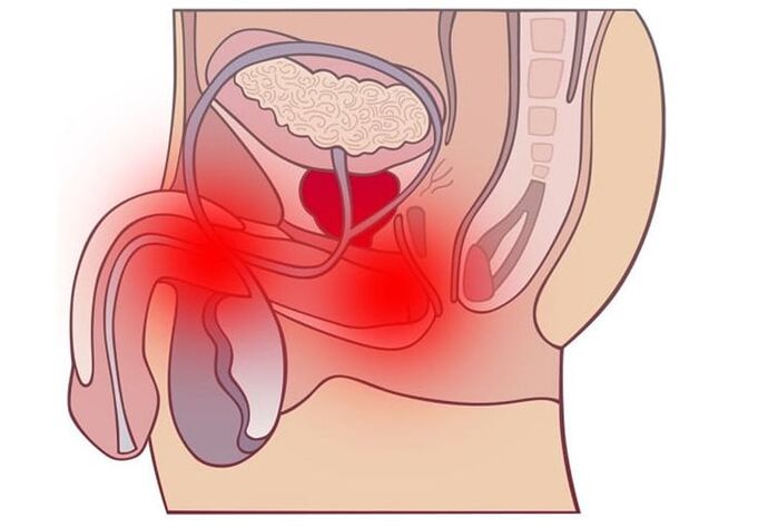 Metodi per il trattamento della prostatite