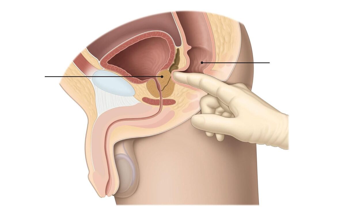 Tecnica di massaggio prostatico