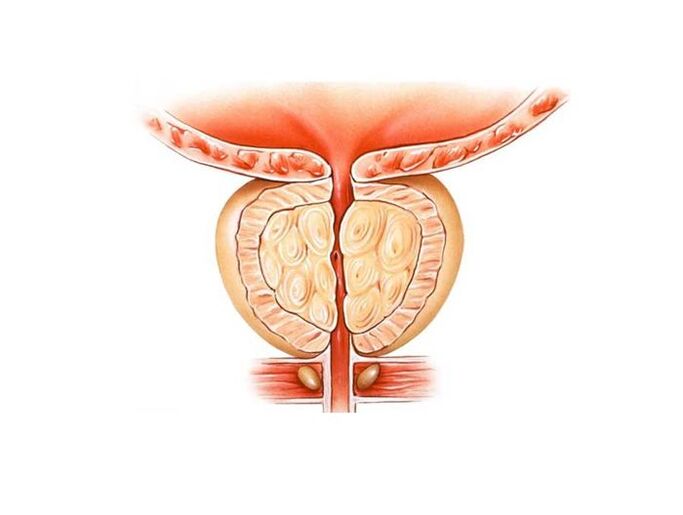 Trattamento della prostatite con rimedi popolari